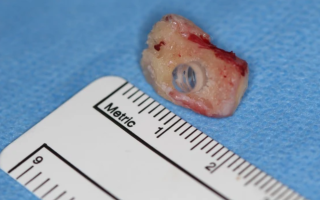 Unique Surgery in Vancouver Aims to Restore Vision